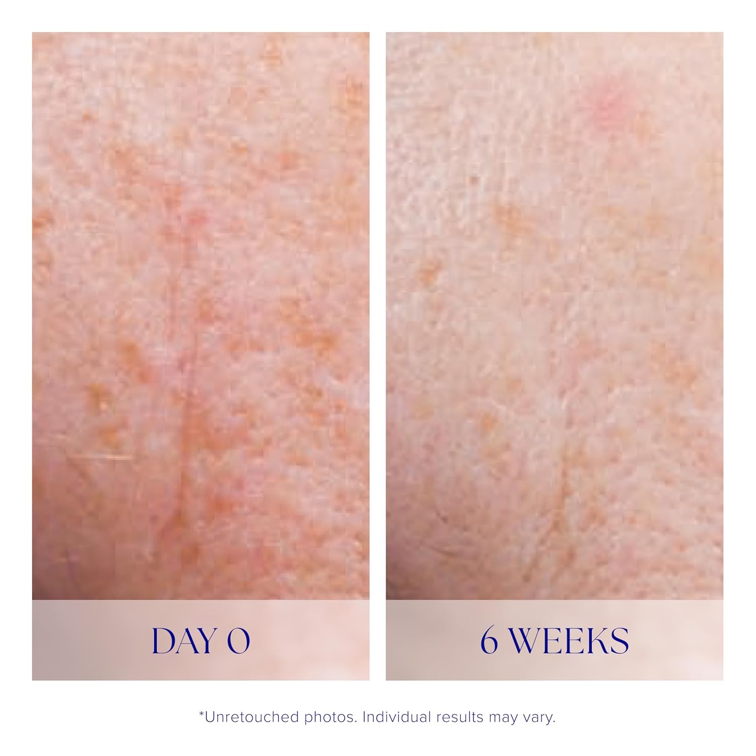 iS CLINICAL Active Serum - Visibly evens skin tone, Excellent for acne-prone skin, Anti-Aging Face Serum - Image 5